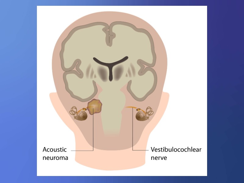 Graphic showing an acoustic neuroma