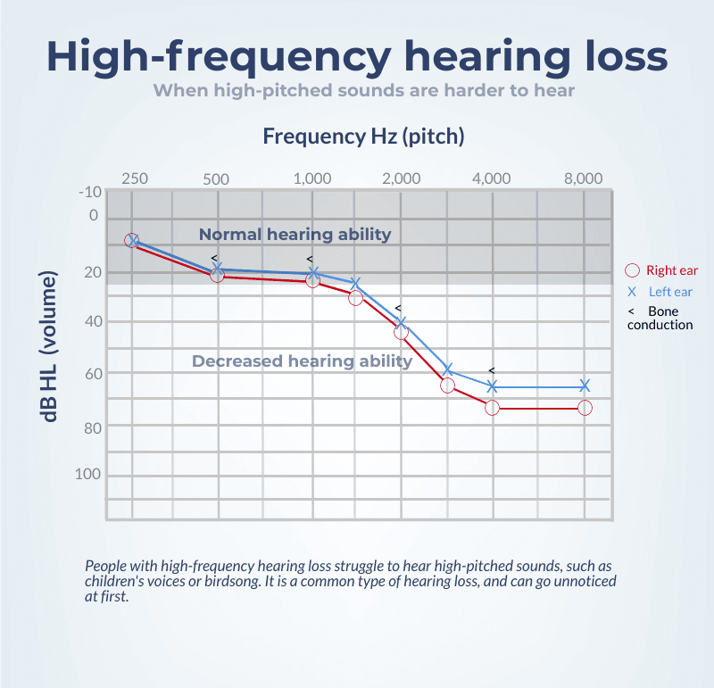 An audiogram showing high-frequency hearing loss.