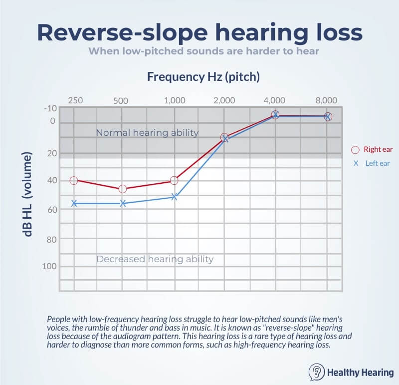 Audiogram showing reverse slope (low frequency) hearing loss