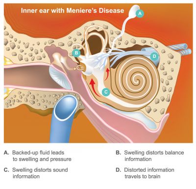 Diagram of the inner ear showing Meniere's disease