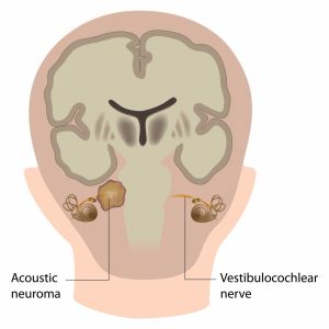 Graphic showing acoustic neuroma