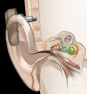 depiction of sound transmitting from the BAHS to the inner ear