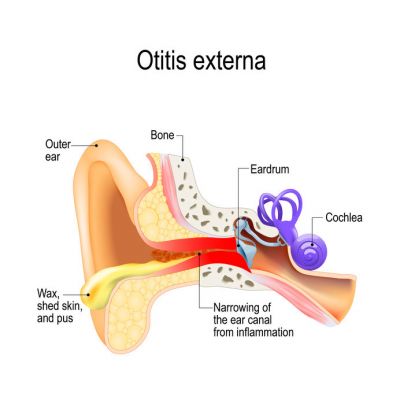 An anatomical view of otitis externa