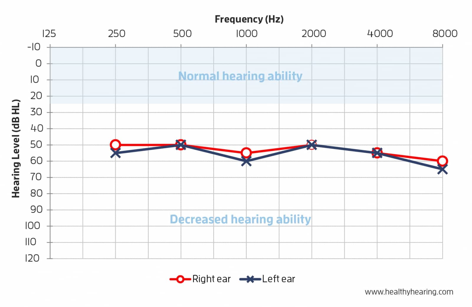 A basic audiogram showing hearing loss. 