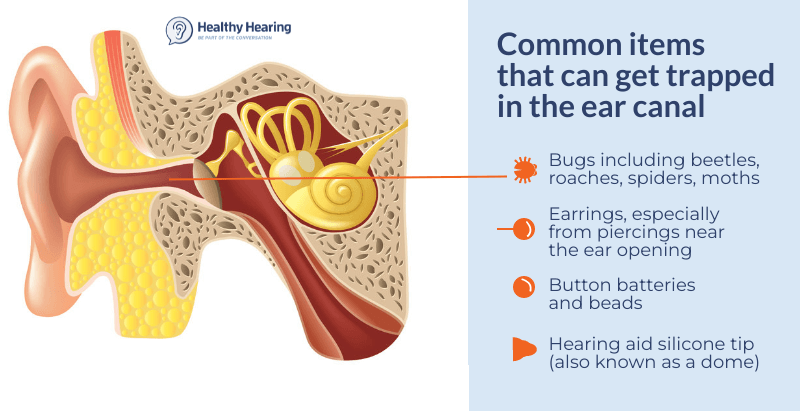 Infographic explaining that bugs, beads, batteries, hearing aid domes and other things can get stuck or trapped in the ear canal. 