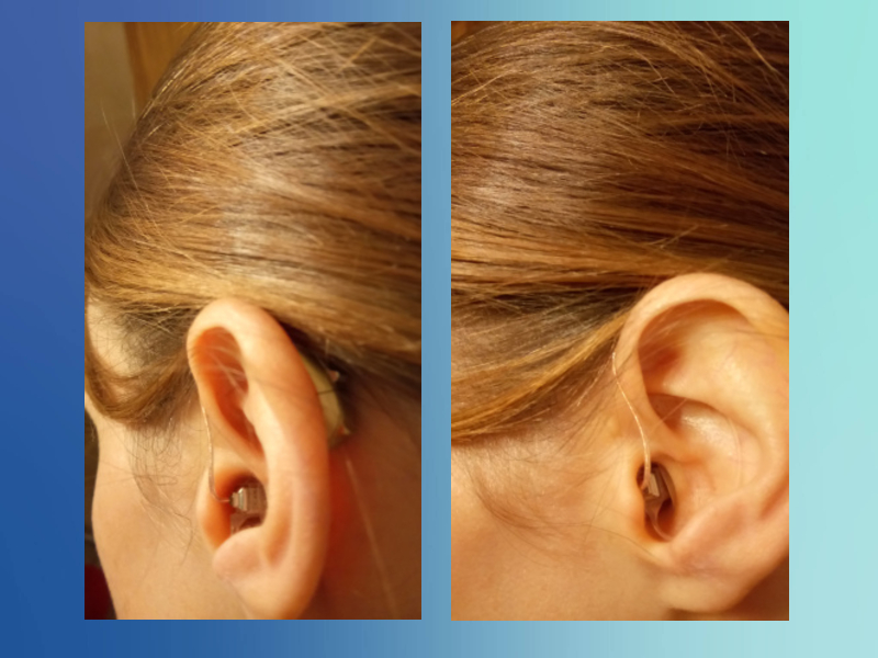CROS hearing aids for single-sided deafness - My experience