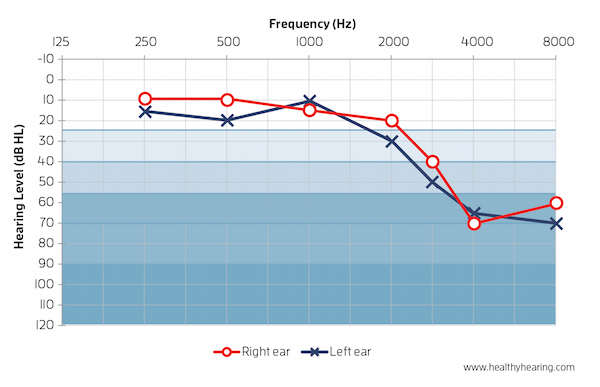 Hearing Loss Frequency Chart