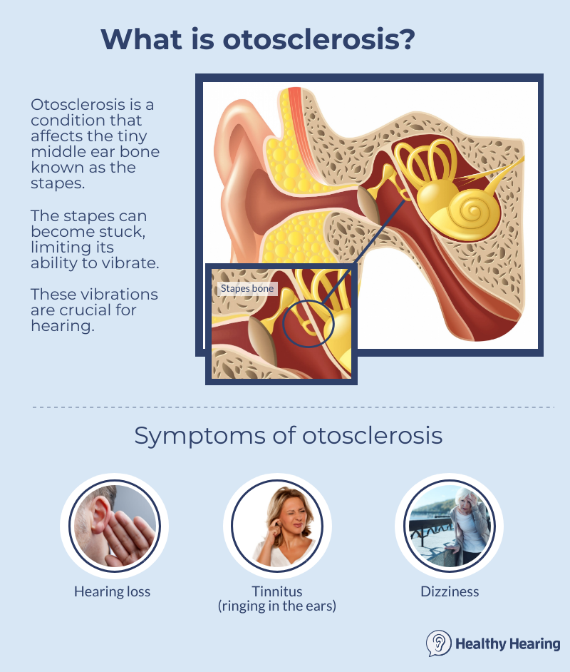 Illustration of otosclerosis