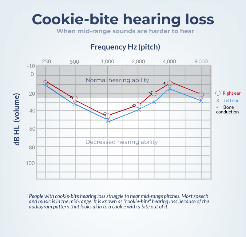 Audiogram showing cookie-bite hearing loss pattern